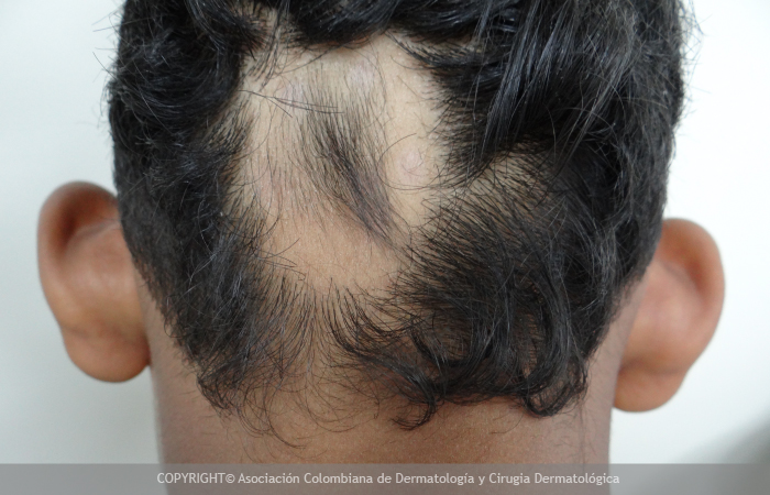 Alopecia areata