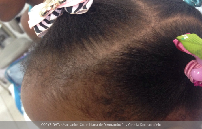 Alopecia por tracción