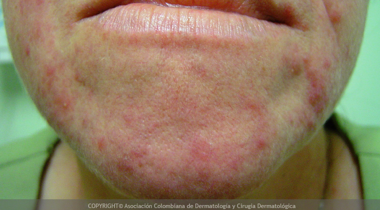 Dermatitis periorificial